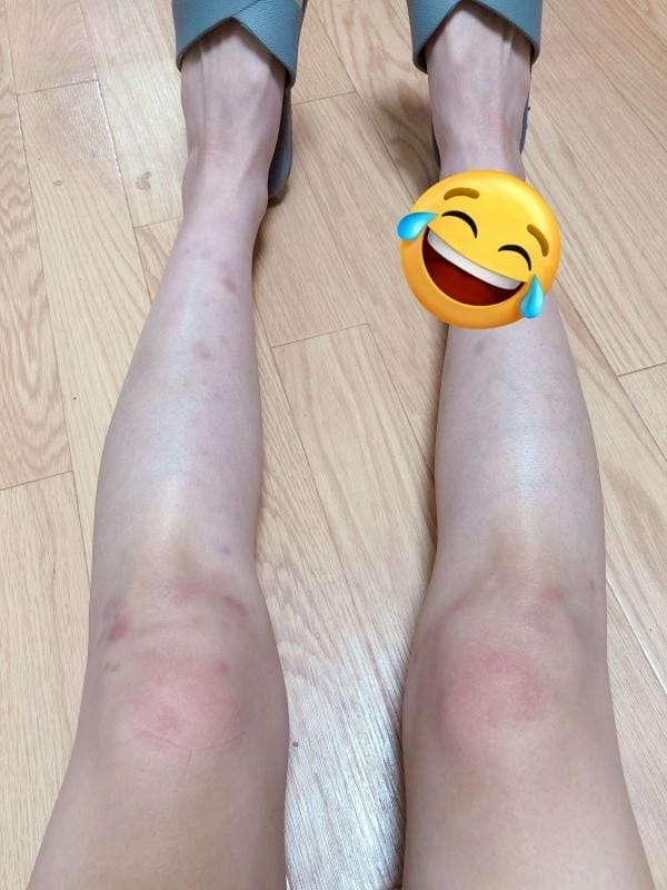 「昨日のとある出来事で ヒザと足全体アザだらけ」11/11(火) 14:41 | チュパカブラの写メ